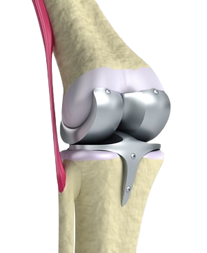 Joint Replacement (Knee & Hip)