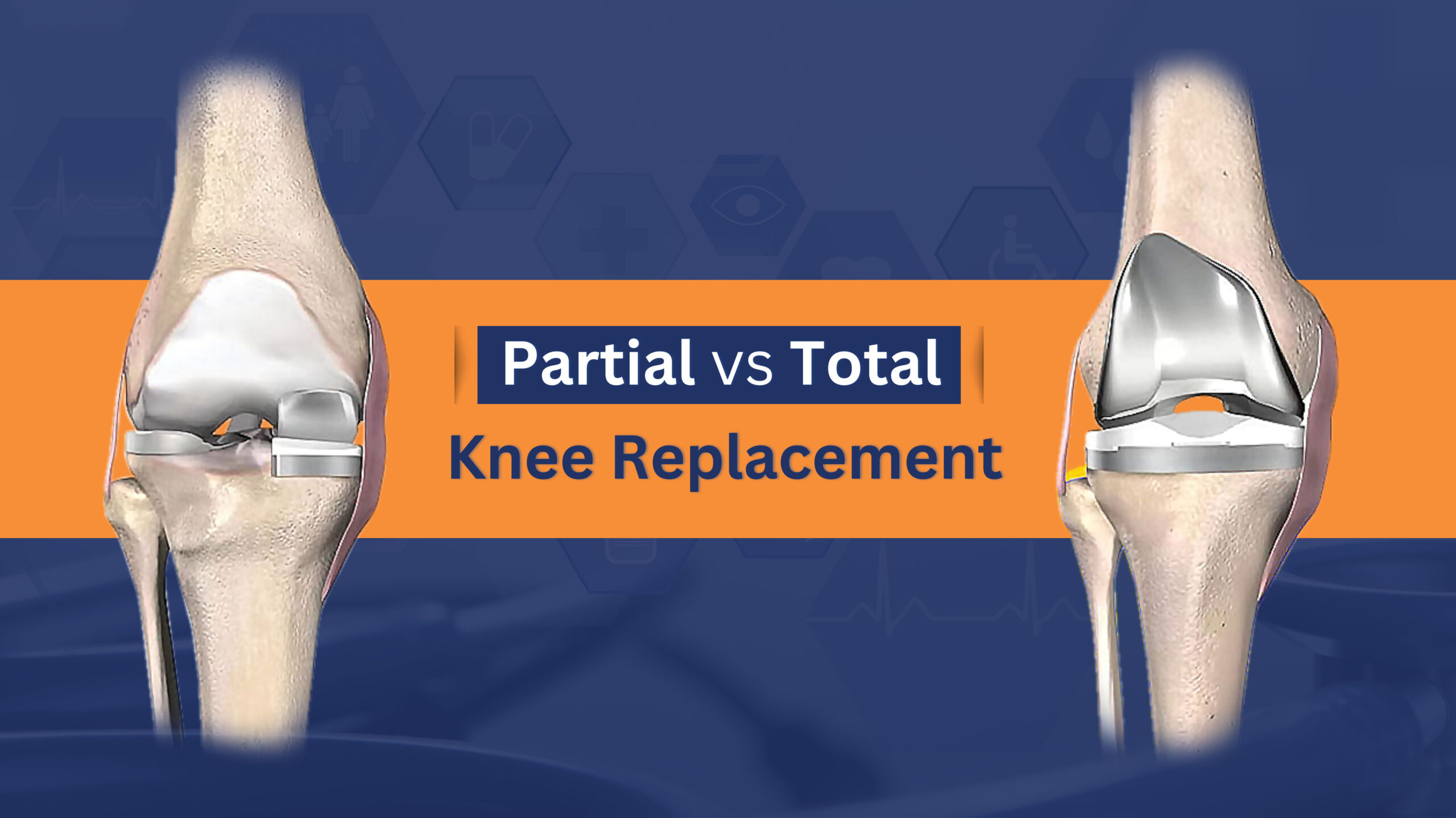 Partial vs Total Knee Replacement